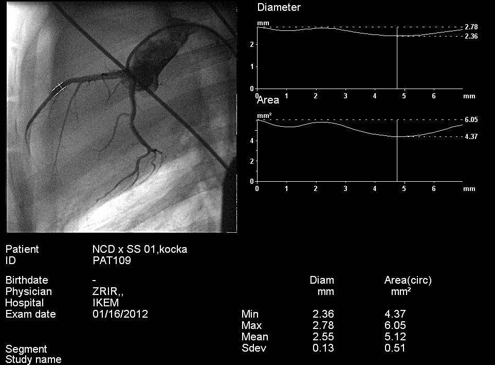 Obrázek 11. Kvantitativní koronární angiografie k nalezení segmentu ramus interventricularis anterior o průměru 2.5 mm.
