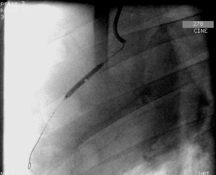 Obrázek 12. Implantace stentu o průměru 3.0 mm do segmentu RIA s průměrem 2.5 mm, tedy poměr velikosti stentu k velikosti tepny je 1.2. Optimální výsledek po implantaci stentu a také absence komplikací, jako například trombózy nebo disekce na hraně stentu, byly potvrzeny angiograficky.