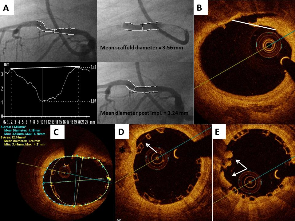 Obrázek 15. Měření pomocí kvantitativní koronární angiografie a optické koherenční tomografie. A: QCA měření před implantací stentu Absorb, během inflace balonku a ihned poté.