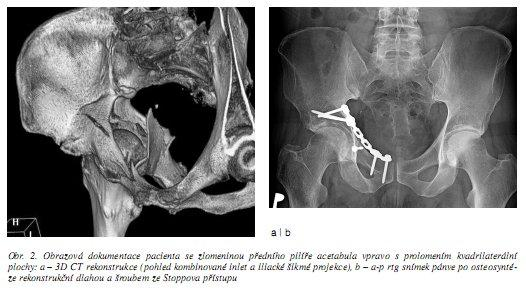 acetabula a pánevního kruhu a jeden pacient měl izolované poranění pánevního kruhu.
