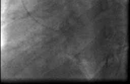 Aortální regurgitace invazivní vyšetření Při jasném echu jen koronarografie k posouzení stavu