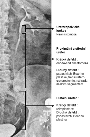 204 výkonu, patří zkušenost chirurga a počet výkonů na pracovišti. Akutní chirurgická explorace a pokročilý nádor přispívají k vyššímu počtu komplikací.