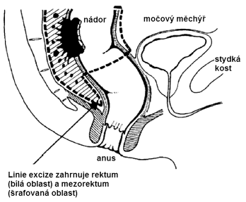206 Obrázek 4. Rozsah resekce při totální mezorektální excizi (25) a tím také života pacientů po operacích.