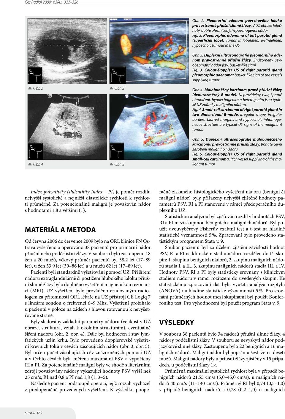 basket-like sign) Fig. 3. Colour-Doppler US of right parotid gland pleomorphic adenoma: basket-like sign of the vessels supplying tumor Obr. 2 Obr. 3 Obr. 4 