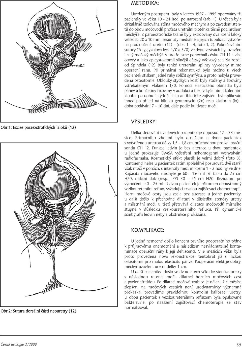 Z paraexstrofické tkáně byly excidovány dva kožní laloky velikosti 20 x 10 mm, sesunuty mediálně a jejich tubulizací vytvořena prodloužená uretra (12) - (obr. 1-4, foto 1, 2).