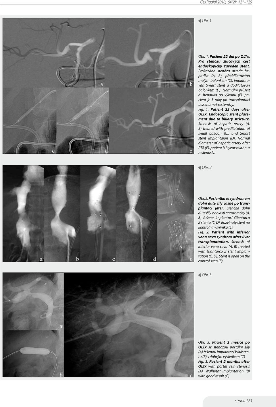 hepatika po výkonu (E), pacient je 3 roky po transplantaci bez známek restenózy. Fig. 1. Patient 22 days after OLTx. Endoscopic stent placement due to biliary stricture.