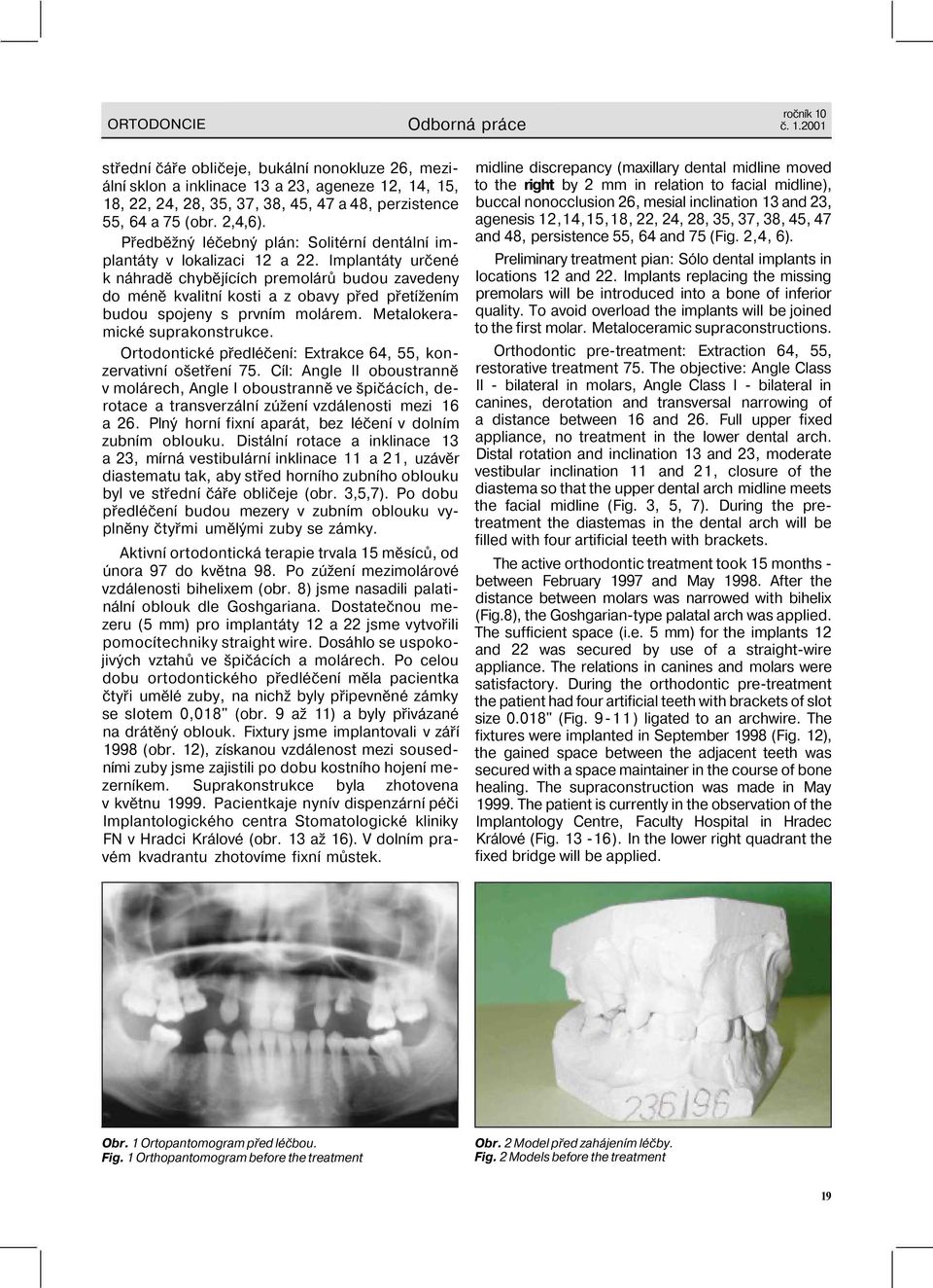 Implantáty určené k náhradě chybějících premolárů budou zavedeny do méně kvalitní kosti a z obavy před přetížením budou spojeny s prvním molárem. Metalokeramické suprakonstrukce.