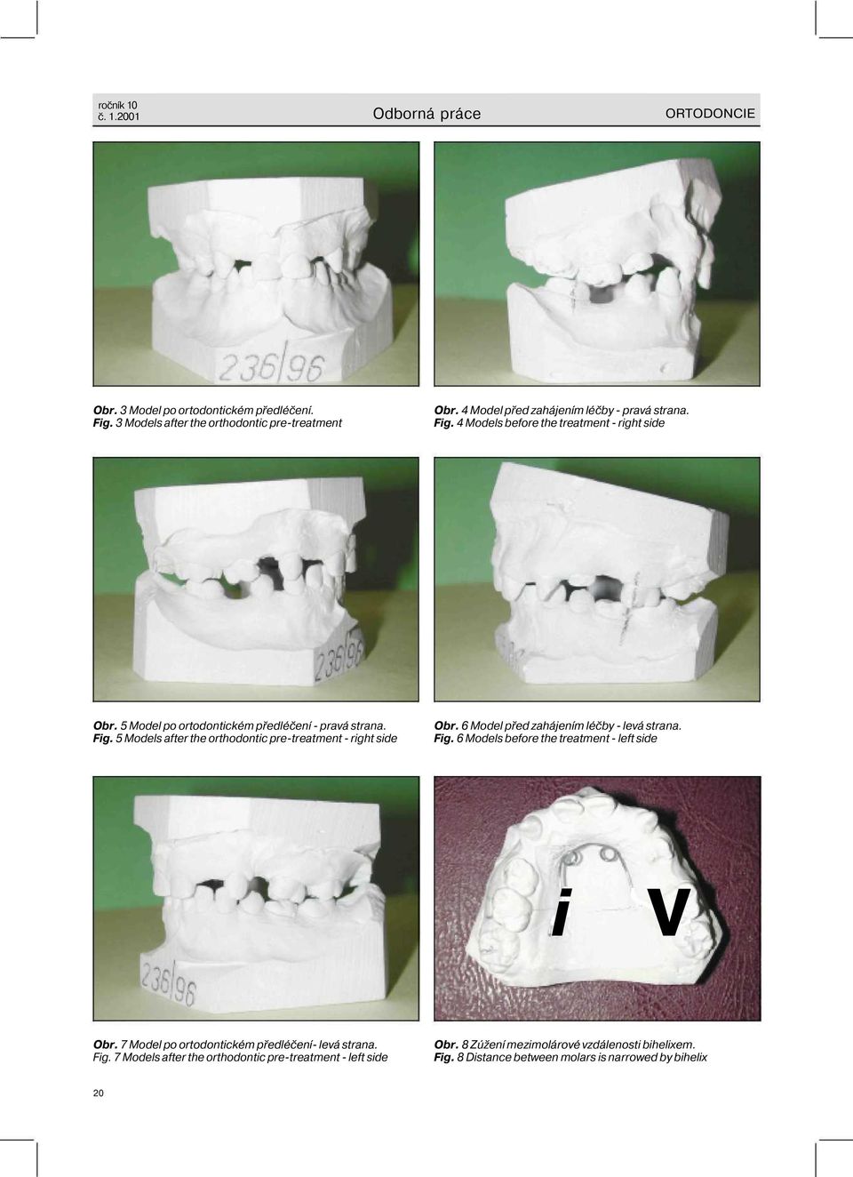 6 Model před zahájením léčby - levá strana. Fig. 6 Models before the treatment - left side i V Obr. 7 Model po ortodontickém předléčení- levá strana. Fig. 7 Models after the orthodontic pre-treatment - left side Obr.