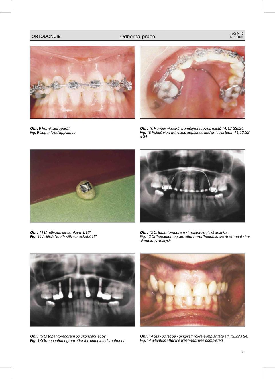 13 Ortopantomogram po ukončení léčby. Fig. 13 Orthopantomogram after the completed treatment Obr.