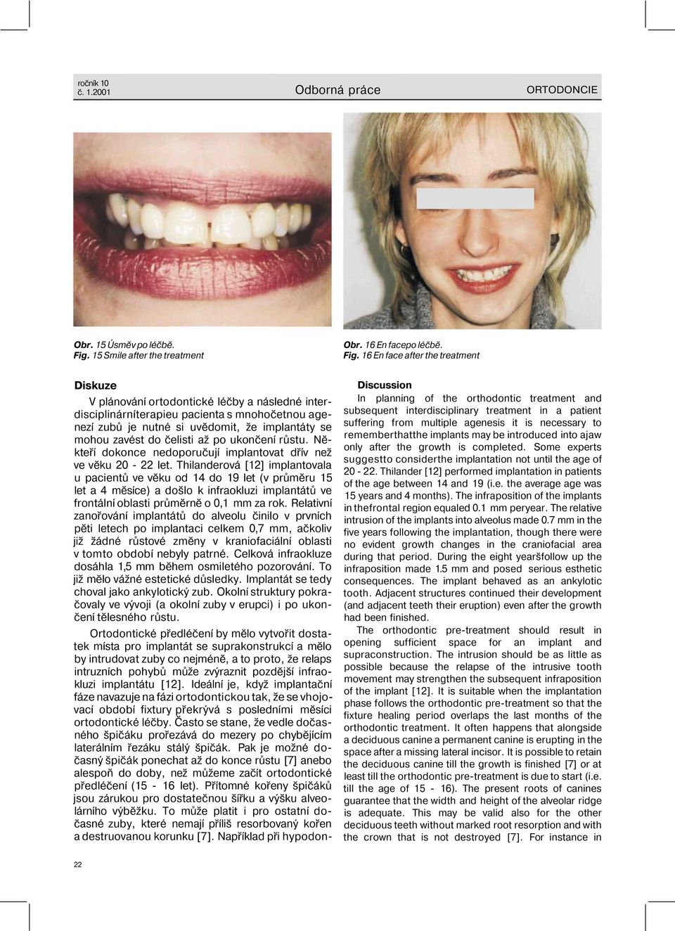 16 En face after the treatment Diskuze V plánování ortodontické léčby a následné interdisciplinárníterapieu pacienta s mnohočetnou agenezí zubů je nutné si uvědomit, že implantáty se mohou zavést do