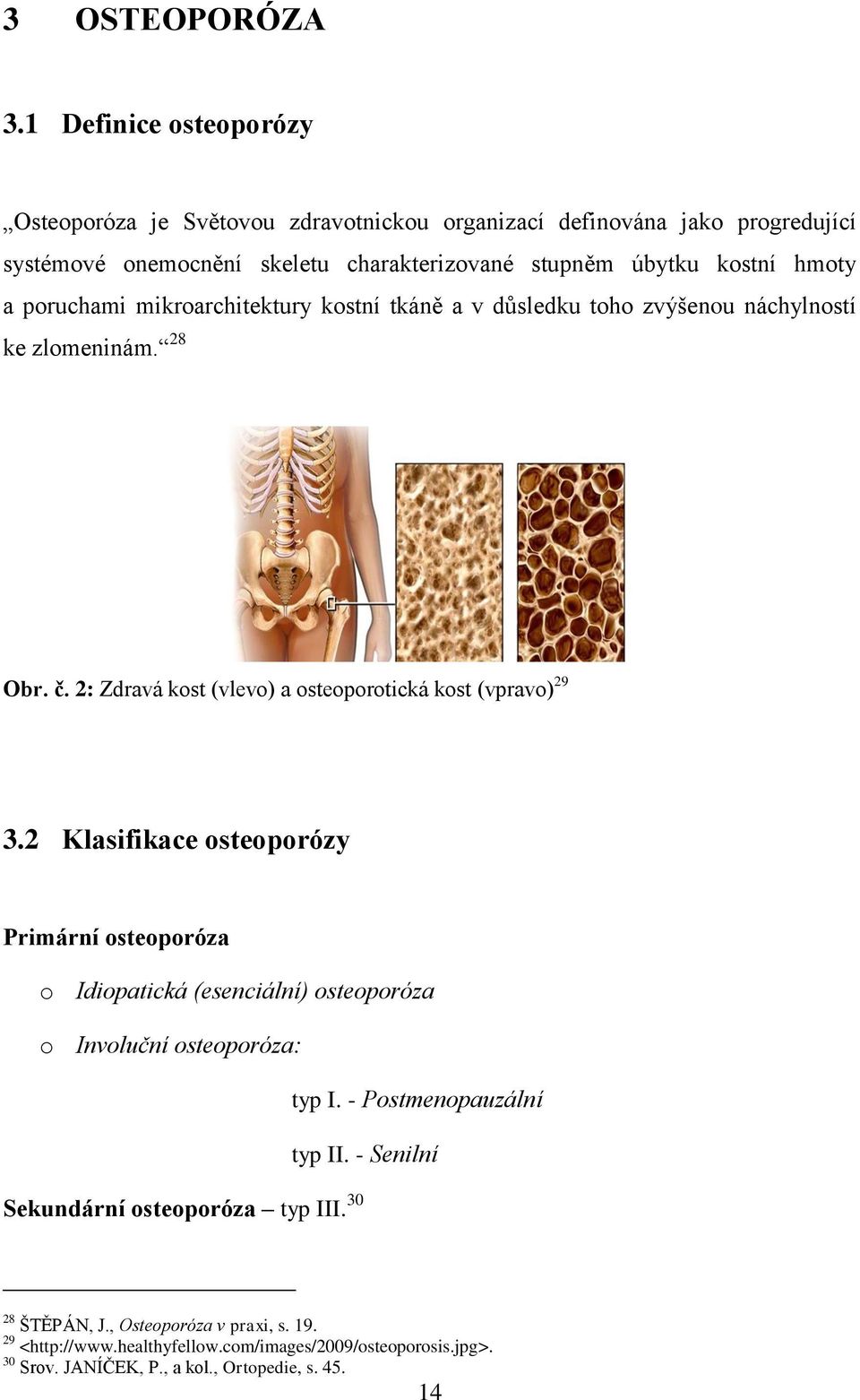 poruchami mikroarchitektury kostní tkáně a v důsledku toho zvýšenou náchylností ke zlomeninám. 28 Obr. č. 2: Zdravá kost (vlevo) a osteoporotická kost (vpravo) 29 3.