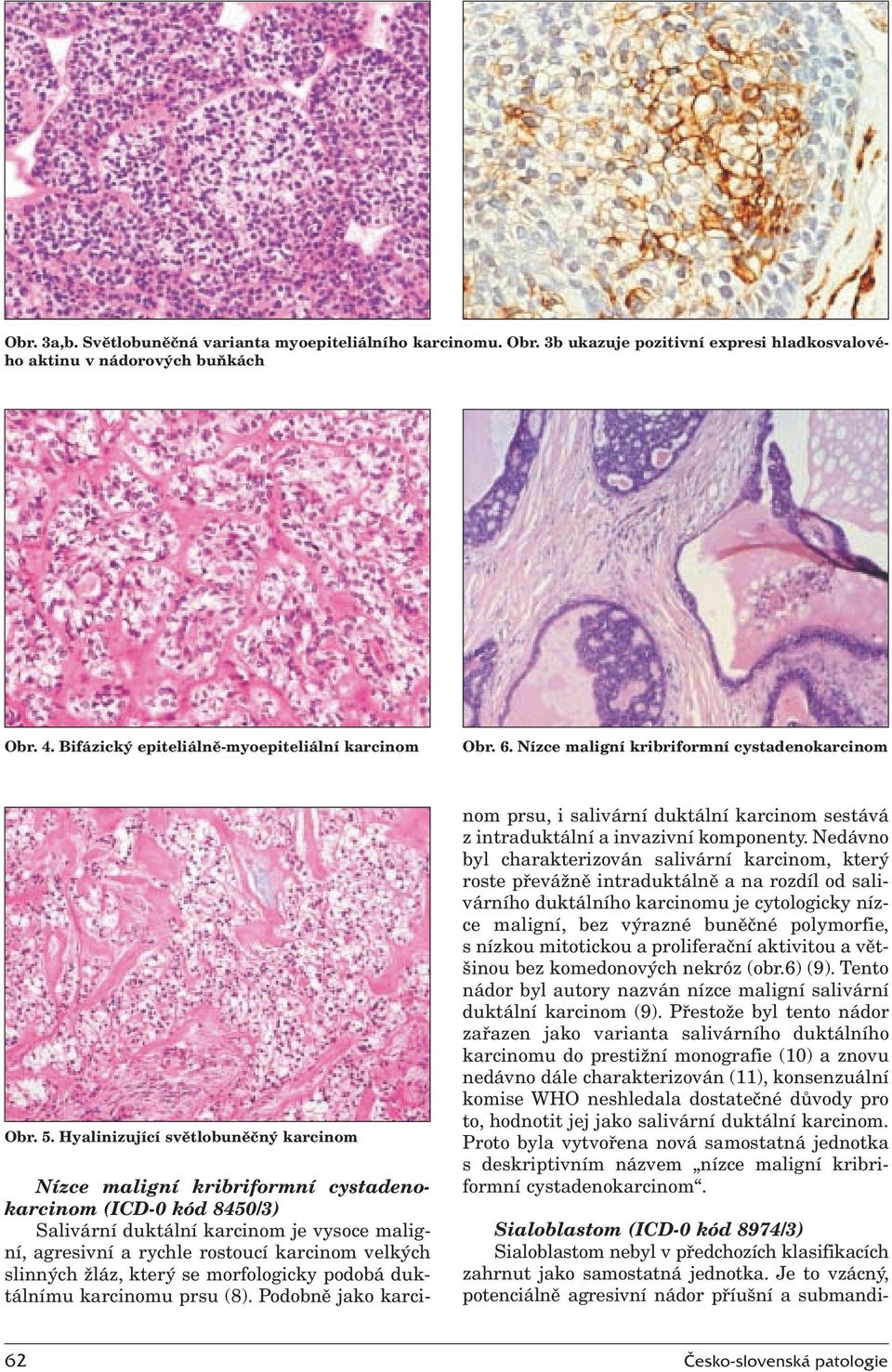 Hyalinizující světlobuněčný karcinom Nízce maligní kribriformní cystadenokarcinom (ICD-0 kód 8450/3) Salivární duktální karcinom je vysoce maligní, agresivní a rychle rostoucí karcinom velkých