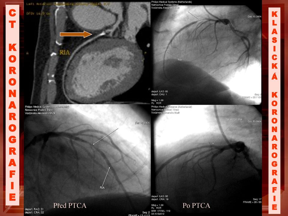 PTCA K L A S I C K Á K
