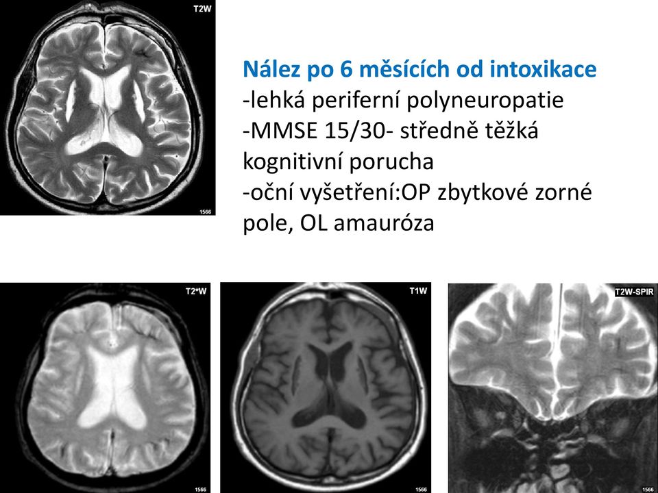 středně těžká kognitivní porucha -oční