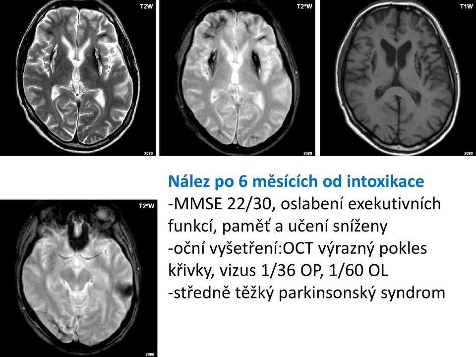 sníženy -oční vyšetření:oct výrazný pokles