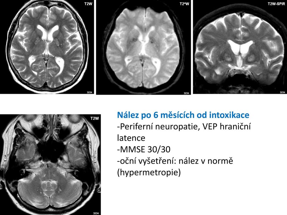 hraniční latence -MMSE 30/30