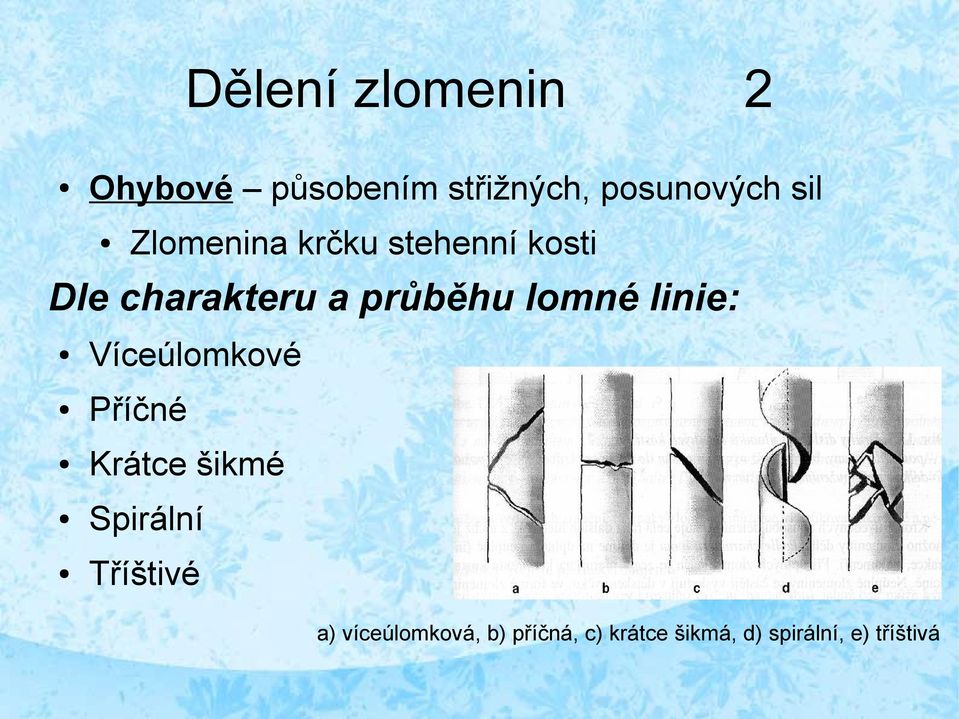 linie: Víceúlomkové Příčné Krátce šikmé Spirální Tříštivé a)