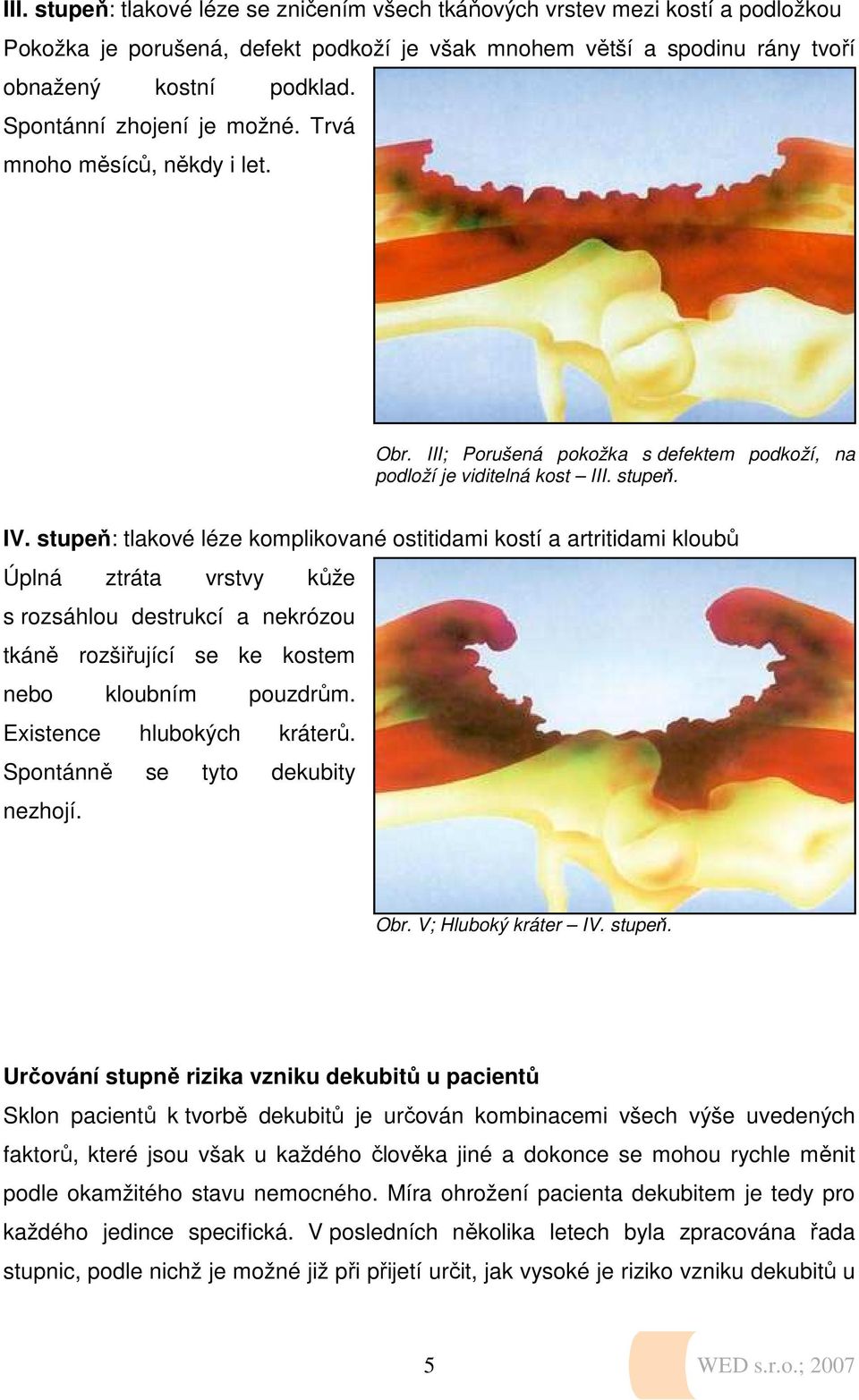 stupeň: tlakové léze komplikované ostitidami kostí a artritidami kloubů Úplná ztráta vrstvy kůže s rozsáhlou destrukcí a nekrózou tkáně rozšiřující se ke kostem nebo kloubním pouzdrům.