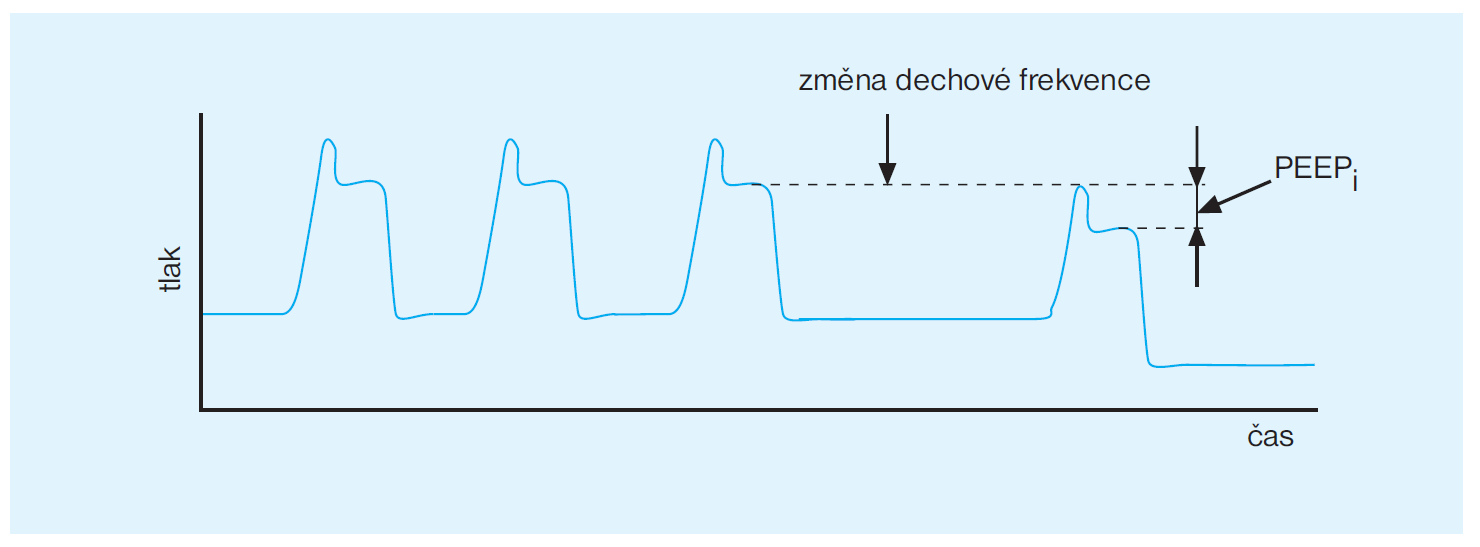 dechového cyklu nemění Crs, jsme schopni kalkulovat hodnotu PEEPi, blízkou hodnotě PEEPi,stat. Obr.