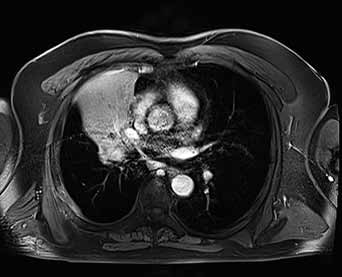 Obr. 2B Obr. 2A Obr. 2. MALT lymfom plíce vpravo na koronárním T2 STIR obrazu a na axiálním postkontrastním obrazu VIBE T1 Fig. 2. MALT lymphoma of the right sided lung on coronal T2 STIR and axial VIBE image after application of contrast material Tab.