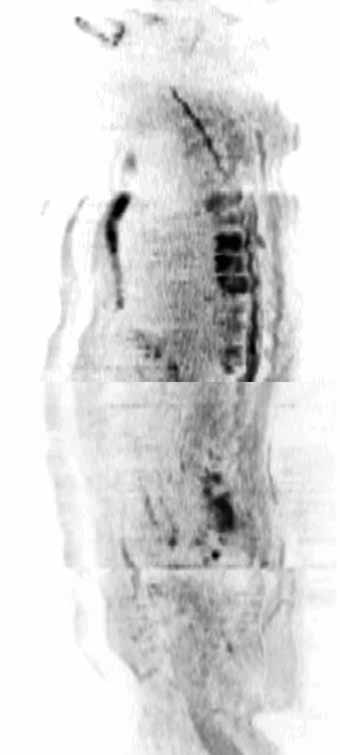 Obr. 4C Obr. 4B Obr. 4A Obr. 4. Karcinom prostaty s postižením skeletu metastázami.