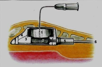 1.2 Složení a druhy portů Autor uvádí, implantabilní žilní port je systém, který se skládá z komůrky, do které se aplikují farmaka a přes spojovací systém vede intravenózní katetr, který je zaveden