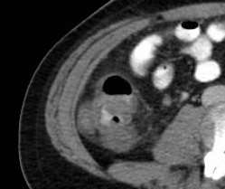 Pancolitis s