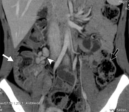 Neutropenická kolitida (typhlitis) Poškození mukózy, pravé colon, může být ale zasaženo i ileum a transversum.