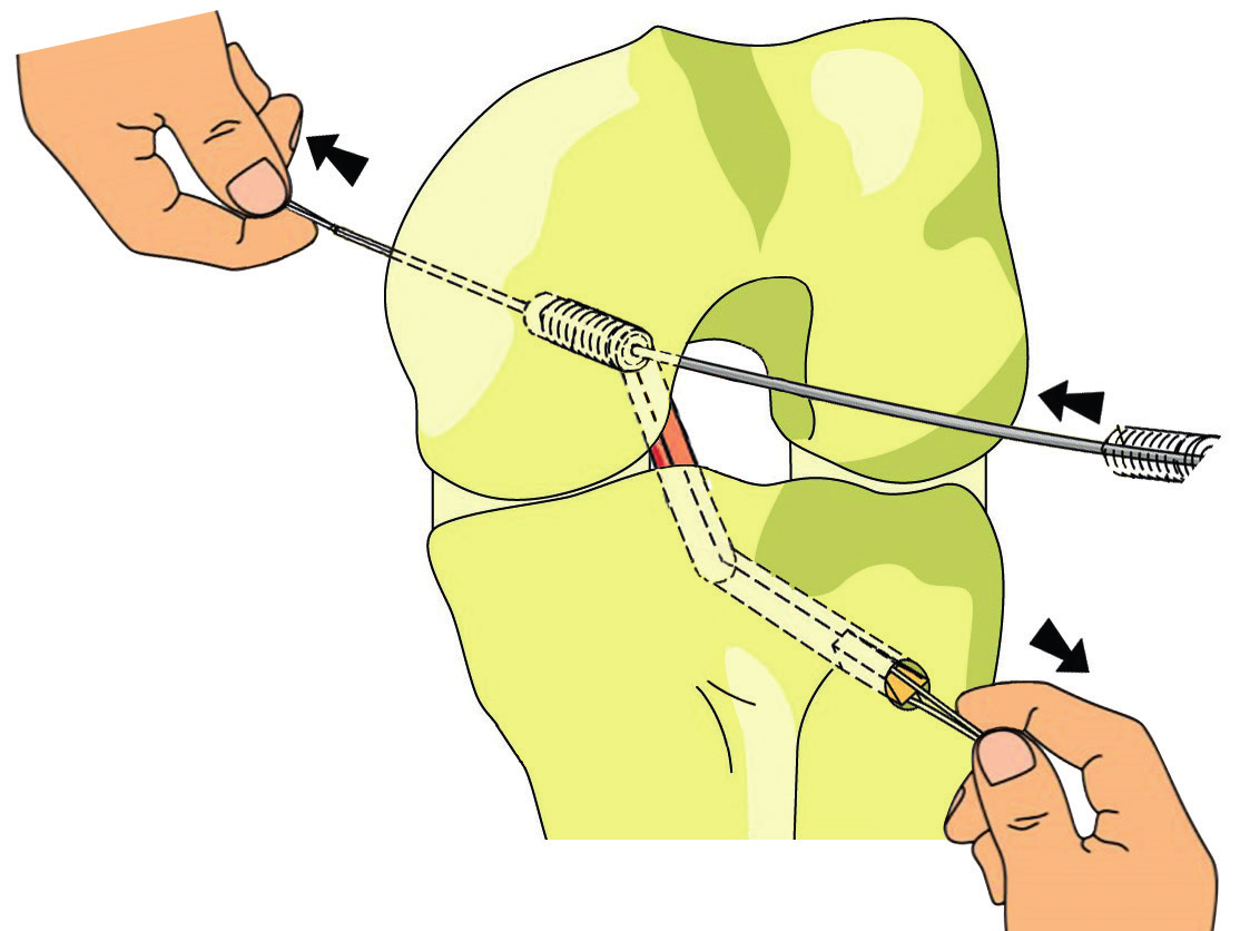 2. Zavedení štěpu Pomocí drátěné kličky zaveďte silné silonové vlákno (případně i drátěnou kličku) do tibálního a poté po protažení přes interkondylickou fosu i do femorálního kanálu.