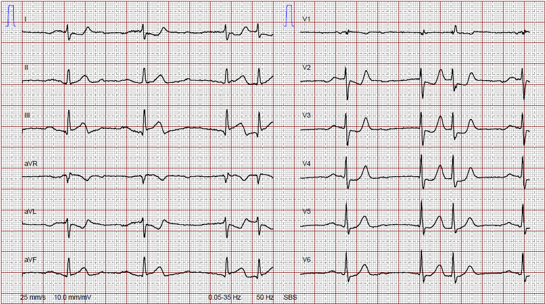A 56 year old mechanically ventilated man suddenly becomes bradycardic and