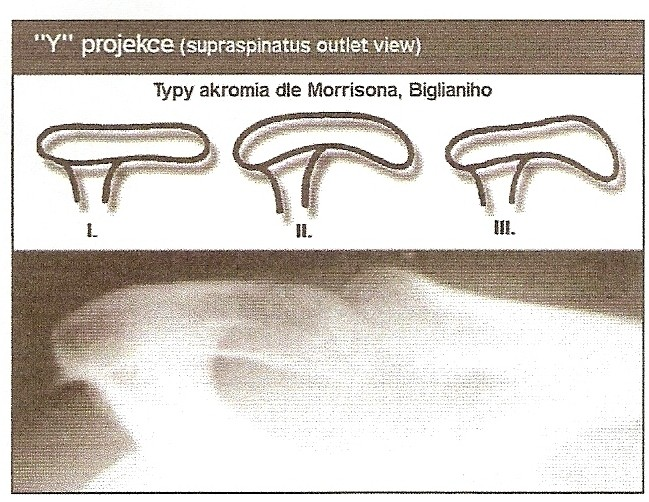 1.1.4.2 Pomocná vyšetření - Klasický rentgenový snímek ramenního kloubu v předozadní a kolmé axiální projekci.