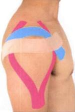 Kinezio-taping může být využíván v oblasti ramene například u impingement syndromu nebo instability ramenního kloubu a bylo popsáno použití i u subluxace ramene (Walsh, 2010).