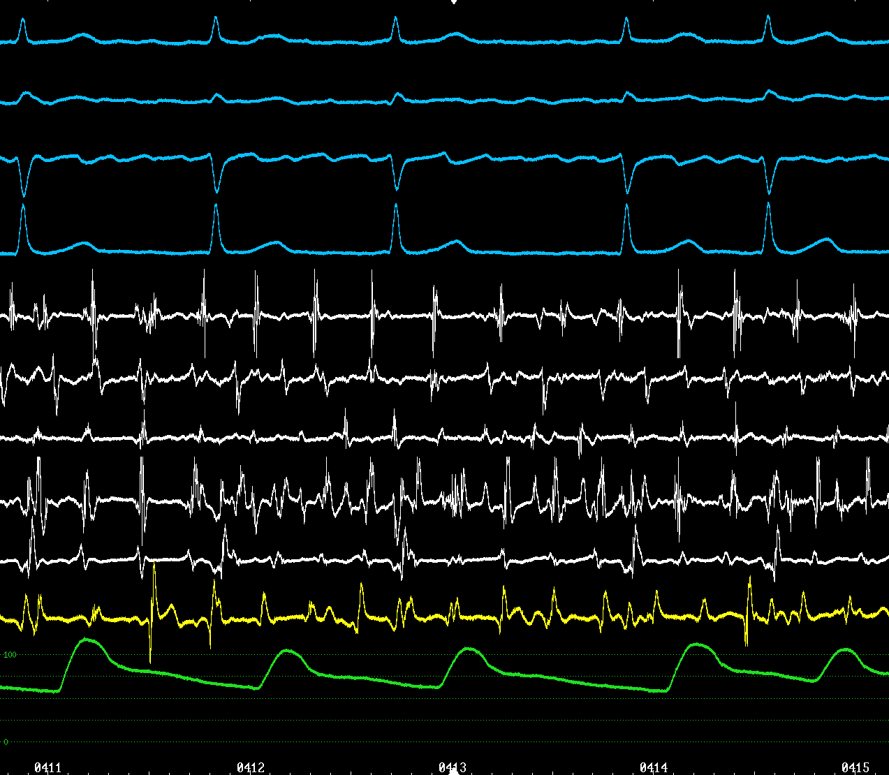 I avf V1 V6 CS9.10 CS7.