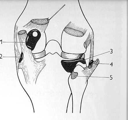 na tibii do area intercondylaris anterior et posterior. Obvod menisků je připojen ke kloubnímu pouzdru. (Čihák, 2001). 1.3 Burzy kolenního kloubu Obr.