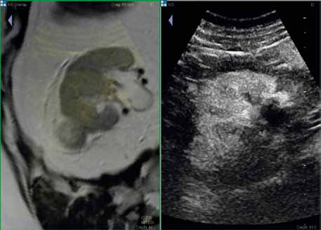 Obr. 5 Obr. 5. Fúze MR a CEUS. Nativní MR sekvencí T2 TSE zobrazeno ložisko v pravé ledvině. Na CEUS je zřetelné sycení tohoto ložiska. Histologicky onkocytom. Fig. 5. Fusion of MRI and CEUS.
