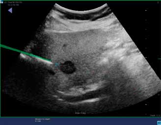 Obr. 6 Obr. 6. Biopsie jaterního ložiska navigovanou jehlou. Zeleně je zobrazena virtuální poloha jehly odpovídající poloze skutečné jehly.