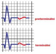 9. T vlna T vlna reprezentuje na EKG záznamu repolarizaci komorového myokardu.