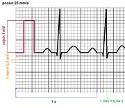 Popis EKG Je důležité si vždy před měřením ujasnit jednotky a jejich poměr v EKG záznamu! To lze určit z tzv.