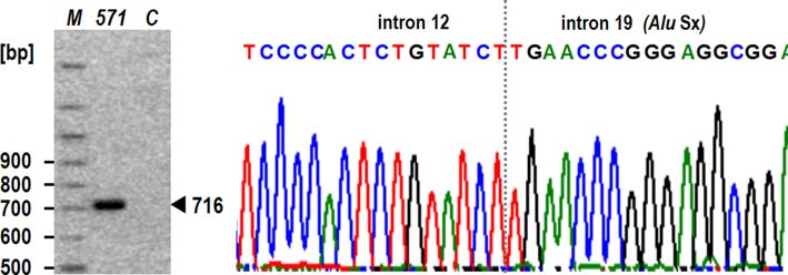 Breast Cancer Res Treat Fig. 3 Breakpoint analysis of a complex genomic rearrangement comprising deletion of exons 5 10 and insertion of 35 nucleotides using LR-PCR (left) and sequencing (right).