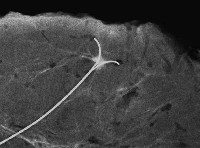 2. Fáze: chirurgický výkon a) odběr vzorku tkáně, orientace exstirpátu chirurgem označení b) provedení specimen radiografie informace od radiologa operatérovi o úspěšnosti výkonu c) spolupráce