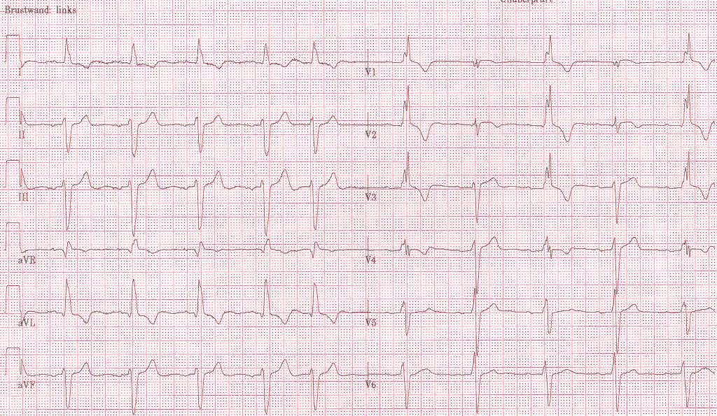 Alternující raménková blokáda Indikace KS z EKG či holtera bez analýzy anamnézy a korelace symptomů a arytmie Indikace KS u asympomatických pauz kolem 3s při fibrilaci síní Posuzovaní fyziologické