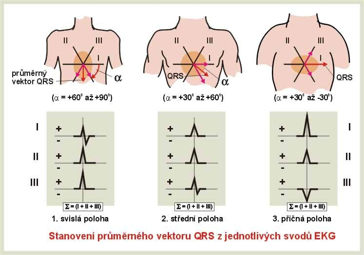 - 38 - depresi úseku ST nad isoelektrickou linií nebo pod ní. Pro tuto změnu ST může být odvozen zvláštní vektor.