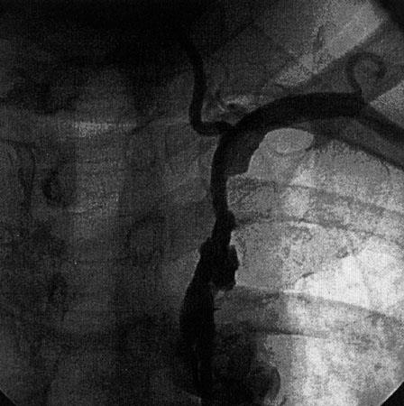 Coronary steal syndrom Jen 0.15%- 0.