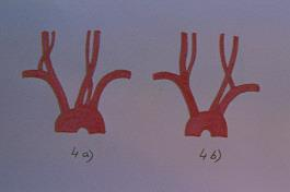 Subclavian steal syndrom - typy Zvláštní případy za normální anatomické situace by šlo o