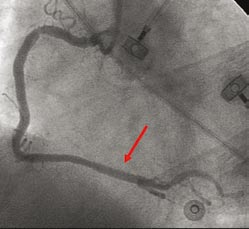 Obr. 1. Vstupní EKG obraz STEMI inferolaterálně. Tab. 1. Laboratorní hodnoty. Maximální propuštění Norma bilirubin 25,8 µmol/ l 2 21 µmol/ l ALT 1,51... 0,88 µkat/ l 0,17 0,85 µkat/ l AST 3,43.