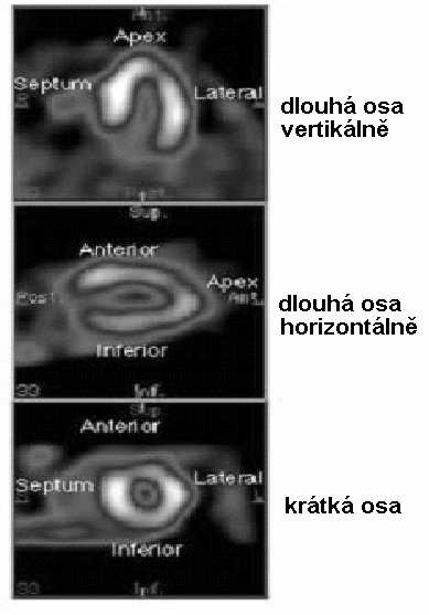 SPECT obrazy http://www.physics.ubc.ca/~mirg/home/tutorial/applications.html#heart Perfuze srdce.