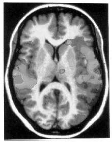 Kombinování MRI a PET www.eihms.