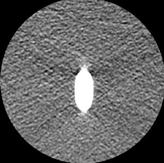 Artefakty vzniklé vlivem Cone Beam akvizice -CBCT artefakty V rámci obličejové chirurgie je využívána technologie CT s kuželovým paprskem tzv. Cone Beam CT.