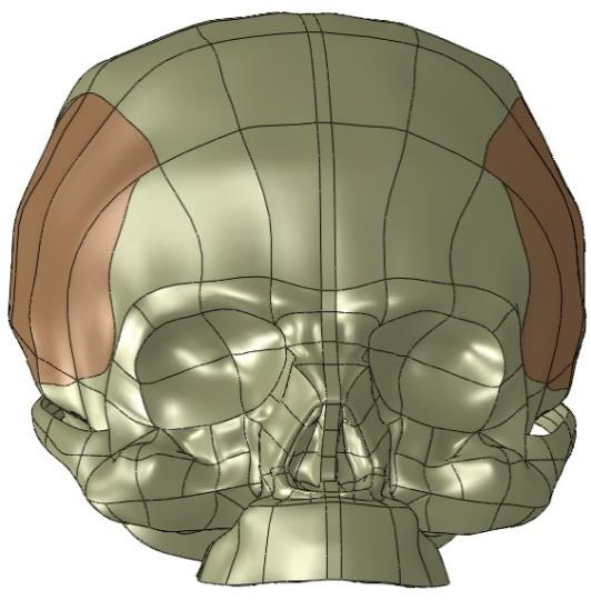 TM disky TM chrupavky kortikální kostní tkáň spongiózní kostní tkáň Obr. 9.4 Model geometrie lebky Obr. 9.5 Výsledný model geometrie fyziologické dolní čelisti 9.1.