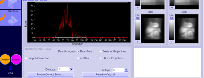 Obr. 9B Kontrola kvality u pacienta s fibrilací síní histogram tepové frekvence má tvar Gaussovy křivky a v tomto případě lze ještě data gated SPECT hodnotit (u jiných pacientů s fibrilací síní však